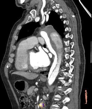 Angio-TC. Disección aórtica aguda tipo B que afecta a aorta torácica descendente y carótida común izquierda. Dilatación de aorta torácica.