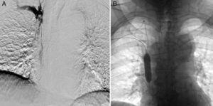 A) Fibrinólisis mediante 2 catéteres, vía cefálica derecha y basílica izquierda. B) Angioplastia transluminal percutánea de estenosis residual en vena cava superior.
