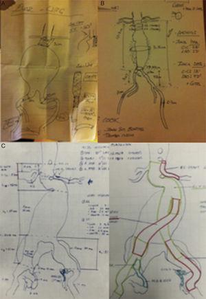 Modelos reales de planificación en terapia EVAR, recomendamos que este documento permanezca siempre visible durante el procedimiento. A) Situación de urgencia sin disponibilidad de DICOM (no center-lumen-line). B) EVAR programado y disponibilidad de DICOM (con center-lumen-line y cálculo de longitudes). C) EVAR complejo con técnica de chimenea en arteria renal izquierda, embolización hipogástrica izquierda y endoprótesis ilíaca ramificada (IBE) derecha. Cortesía Dr. N Mosquera.