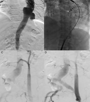 Segundo tiempo quirúrgico endovascular. A) Aneurisma toracoabdominal roto. B) Colocación de endoprótesis. C y D) Arteriografía con integridad de las anastomosis de trasposición de vasos viscerales.