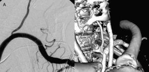 Exclusión del seudoaneurisma de la arteria mamaria interna izquierda tras la implantación de endoprótesis cubierta: A) Control angiográfico intraoperatorio. B) Reconstrucción 3D de angio-TC cérvico-torácico donde se observa la endoprótesis y la permeabilidad de la arteria vertebral.
