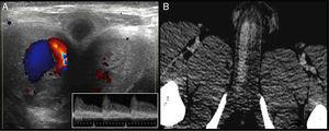 A) Ecodoppler de eje ventral del pene con flujo turbulento a nivel de cuerpo cavernoso derecho. B) Relleno sanguíneo de cuerpo cavernoso derecho.
