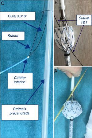 A) Punción y dilatación de la fenestración. B) Precanulación con sutura de seda. C) Subida de catéter sobre guía en renal y sutura de precanulación en paralelo a endoprótesis.