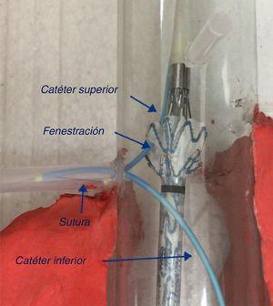 Canulación de catéter inferior en renal que lleva con él la sutura para que el catéter superior (siguiendo esa misma sutura) pase por la fenestración hasta la renal.