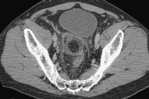 Imagen de tomografía computarizada multidetector pelviana que muestra lesión ovoidea hipodensa (grasa) bien delimitada, con aumento de densidad circundante (reacción inflamatoria), en localización lateral derecha al colon sigmoide.