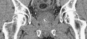 Reconstrucción coronal de tomografía computarizada multidetector pelviana que muestra la citada lesión de densidad grasa con cambios inflamatorios perilesionales.