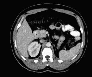Tomografía computarizada D: duodeno engrosado no contráctil con lesión tumoral; P: cabeza de páncreas con metástasis.