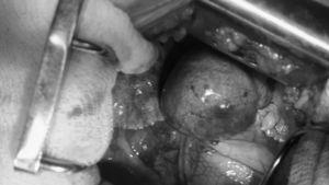 Fotografía intraquirúrgica donde se observa aneurisma de vena cava superior.