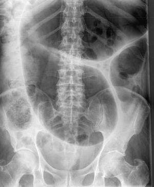 Radiografía simple de abdomen. Signo del grano de café.