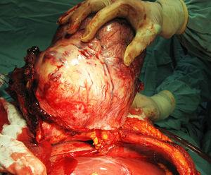 Resección en bloque del tumor de 40 x 30cm en abordaje transabdominal con resección parcial del diafragma derecho (sin invasión a órganos intraabdominales).