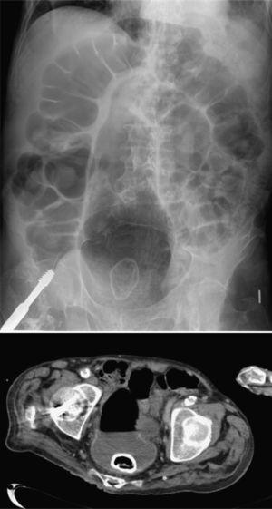 Radiologia simple e imagen del TAC.