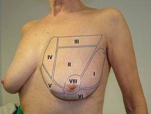 Segmentación mamaria. Exposición de los distintos segmentos mamarios en una visión frontal.