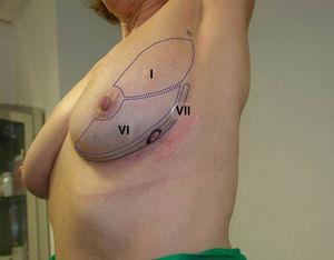 Segmentación mamaria. Exposición de los distintos segmentos mamarios en una visión inferolateral.