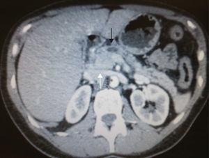 TAC abdominal: dilatación de conducto de Wirsung (flecha negra) hasta cabeza de páncreas que se visualiza aumentada de tamaño, sugestiva de neoplasia (flecha blanca).