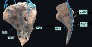 Plexo venoso sacro. VSM: vena sacra media; VSD: vena sacra derecha; VSI: vena sacra izquierda; PVP: plexo venoso presacro; VVBV: venas basivertebrales; SVVI: sistema venoso vertebral interno.