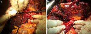 a) Sección de la vena porta derecha. b) Paso de la ligadura del torniquete extraglissoniana para no ocluir la arteria hepática derecha ni la vía biliar derecha.