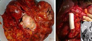 Vista macroscópica del tumor con exposición de la íntima de la vena cava inferior y su reconstrucción con prótesis de PTFE.