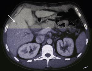 Tomografía computarizada de abdomen tras duodenopancreatectomía cefálica mostrando metástasis hepática de adenocarcinoma de páncreas (flecha).
