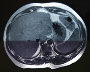 Resonancia magnética realizada 2 años después de la resección hepática mostrando ausencia de enfermedad metastásica.