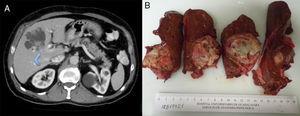 A) TAC abdominal. Flecha azul: infiltración portal tumoral. B) Pieza quirúrgica.