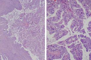 AP: Neoplasia quística formando estructuras papilares, tapizadas por un epitelio glandular atípico productor de mucina. Hematoxilina eosina: foto izquierda 1,25x y foto derecha 40x.