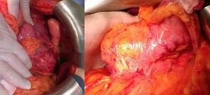 Imagen quirúrgica en donde se visualiza el tumor que afecta a cabeza, uncinado y cuerpo del páncreas.
