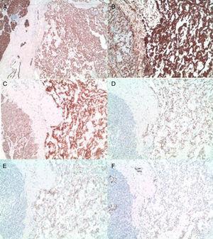 A y B) Expresión difusa e intensa de citoqueratina AE1.3 y vimentina de las células tumorales (10×). C) Sobreexpresión nuclear y citoplasmática de la B-catenina (10×). D) Traslocación nuclear de la ciclina D1 (10×). E y F) Expresión de CD 10 y receptores de progesterona en las células tumorales (10×).