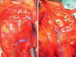 A. Campo quirúrgico con el tumor parcialmente disecado. B. Campo quirúrgico con el tumor resecado. AB: arteria braquiocefálica; ACCI: arteria carótida común izquierda; BVI: vena braquiocefálica izquierda; T: tumor.
