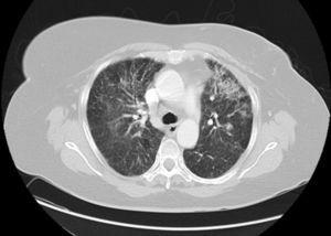 Tomografía computarizada pulmonar que muestra opacidades alveolares bilaterales compatibles con neumonitis.
