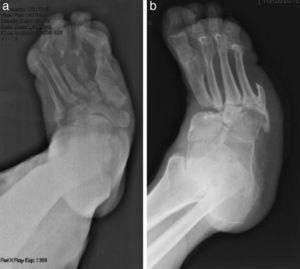 A) Rx que muestra pie de Charcot tipo I de Sanders con afectación de articulaciones metatarso-falángicas. B) Rx que muestra pie de Charcot tipo II de Sanders con afectación de articulación de Lisfranc. Antecedente de amputación del 5.° dedo.