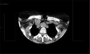 Tomografía computarizada cervicotorácica: lesión en el esófago cervical que cierra prácticamente la luz esofágica.
