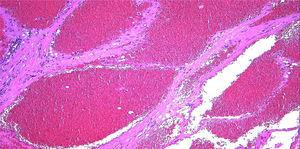 Imagen microscópica de la tumoración submucosa del esófago. Presencia de estructuras vasculares dilatadas, revestidas de endotelio, con contenido hemático en su interior y paredes finas; compatible con hemangioma cavernoso. Hematoxilina- eosina ×20.