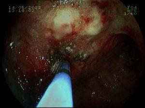 Endoscopia: tumoración mamelonada con hemorragia difusa. Fulguración con argón.
