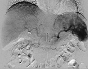 Arteriografías selectivas desde el tronco celíaco y gástrica izquierda. Se cateteriza selectivamente la arteria gástrica izquierda, comprobando la captación selectiva del tumor, cubriendo toda la curvatura menor.