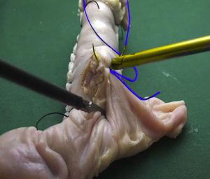 Imagen tomada de vídeo instructivo en endo-trainer de alta definición que muestra cómo realizar las primeras suturas para el cierre de la pared posterior de una gastroyeyunoanastomosis laparoscópica. La aguja y el hilo de la sutura se resaltan en amarillo y azul respectivamente.