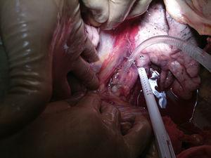 Canulación de la aorta torácica descendente por debajo de la vena pulmonar inferior izquierda.