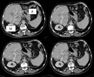 TAC de inicio que muestra la metástasis en segmento IV en contacto con vena porta izquierda y englobando la rama portal de dicho segmento, una de las metástasis en segmento II (M) y un angioma (A).