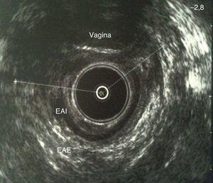 Ecografía endoanal que muestra lesión del ambos esfínteres tras traumatismo obstétrico. Se aprecia a nivel anterior el guante del explorador dentro de la vagina.EAE: esfínter anal externo; EAI: esfínter anal interno.