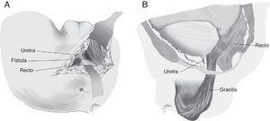 A. Abordaje perineal. B. Cierre orificios rectal y uretral e interposición de gracilis.