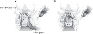 A. Implantación de parche de mucosa bucal sobre la uretra y sutura rectal en 2 planos. B. Interposición gracilis.