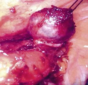 Enucleación toracoscópica de la tumoración esofágica.