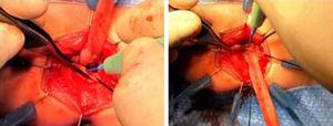 Miotomía posterior del manguito seromuscular rectal para evitar la compresión del intestino descendido.