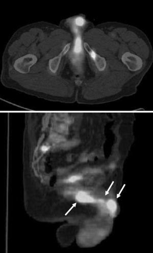 Imagen de 18F-FDG PET/CT. Las imágenes seleccionadas muestran el incremento del metabolismo FDG en las metástasis del pene y el glande (flechas) y en múltiples metástasis óseas.