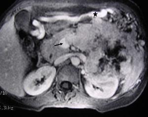 Imagen de RM hepática (mismo caso clínico de la fig. 1). Imagen axial T1 3D con supresión grasa y contraste intravenoso que muestra el tumor neuroendocrino del cuerpo-cola del páncreas, la trombosis tumoral de la vena esplénica (flecha). La voluminosa vena gastroepiploica (asterisco) traduce hipertensión portal segmentaria.