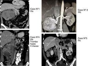 Tumores renales con trombosis de vena cava inferior (casos 1, 2, 4 y 5) con niveles iiia, iiib y iiic, según clasificación de Ciancio et al.11.