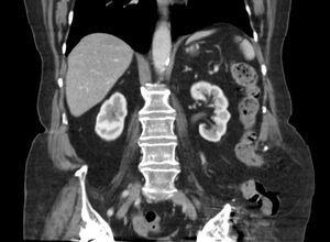 TAC abdominal, sección sagital: intestino grueso en porción extraabdominal sugestivo de hernia transilíaca.