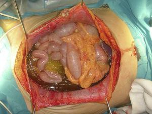 Vista de la cavidad peritoneal tras laparotomía en paciente con PMP secundario a rotura de una neoplasia apendicular mucinosa de bajo grado. Obsérvese la presencia de ascitis mucinosa e implantes mucinosos, también en el área umbilical.
