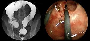 Estenosis de anastomosis colorrectal: a la izquierda, enema opaco con dificultad de paso a nivel de recto superior; a la derecha, imagen de TEM durante la resección del anillo estenótico.