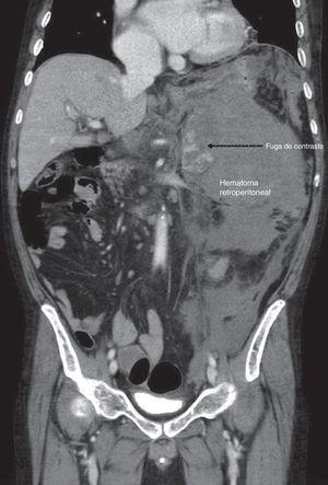 TAC de abdomen. Se evidencia un hematoma retroperitoneal de 15×10×17cm, con fuga de contraste, englobando la glándula suprarrenal izquierda.