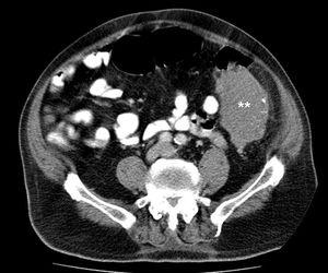 Imágenes de TC de abdomen de tumoración de amiloidosis tipo AL en sigma. Los asteriscos indican una masa de densidad de partes blandas que tiene un diámetro de 96×55mm.